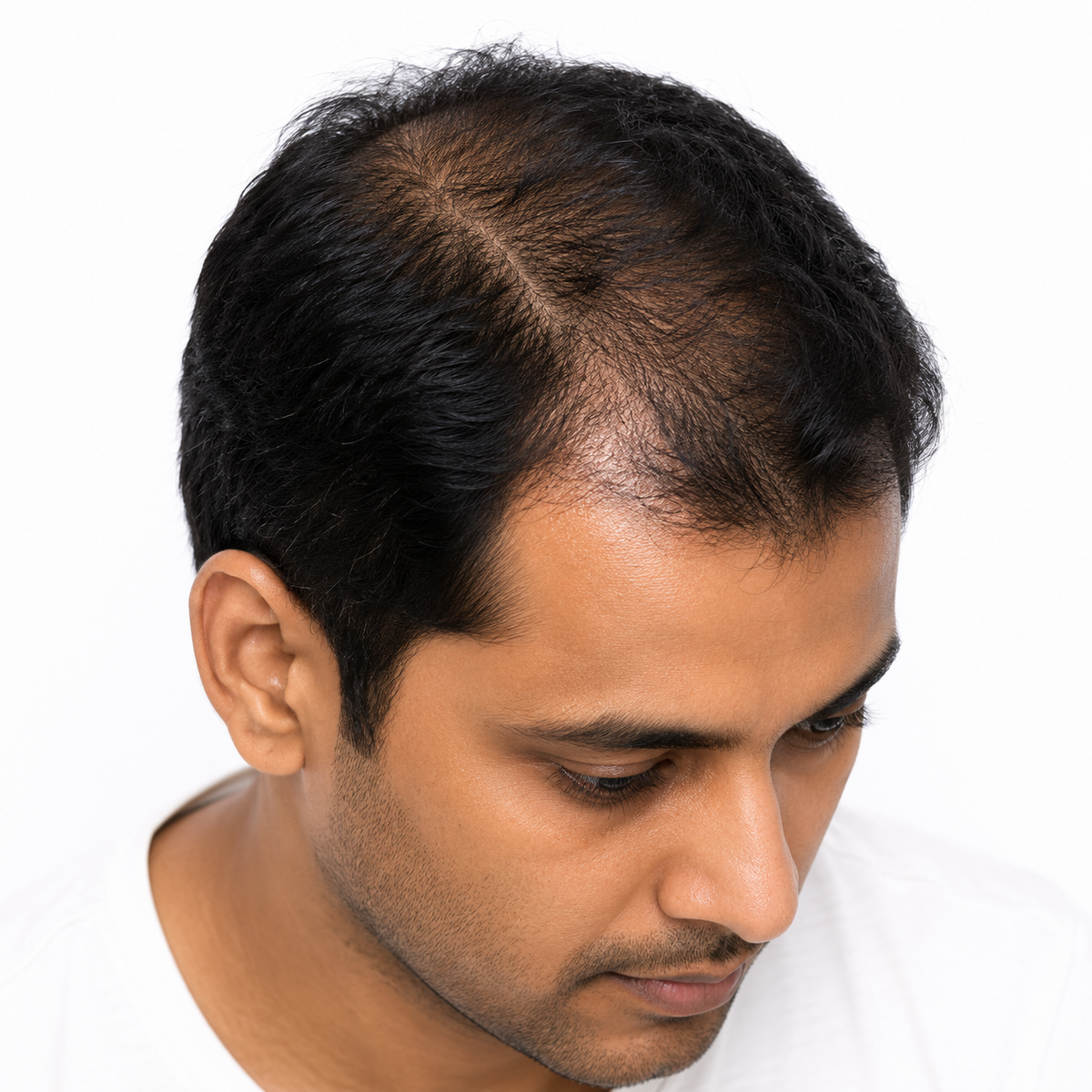 Hair Fall & Thinning